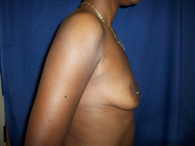 before breast surgery side view