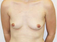 breast enhancement before