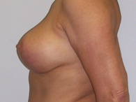 atlanta breast implants after
